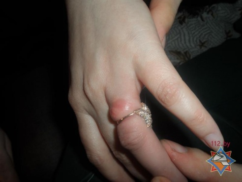 Фотофакт: в Хойниках спасатели освобождали палец женщины от кольца