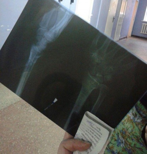 Гололед в Барановичах: «Шла к эндокринологу, попала в травмпункт!»