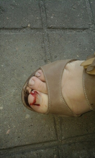 Фотофакт: гомельчанка до крови поранила ногу о торчащий из земли штырь на улице Быховской Фотофакт: гомельчанка до крови поранила ногу о торчащий из земли штырь на улице Быховской